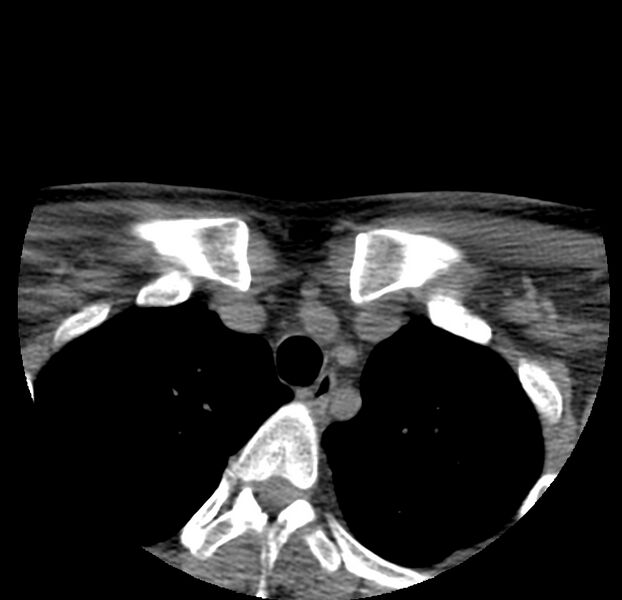 File:Colloid cyst of thyroid (Radiopaedia 22897-22923 Axial non-contrast 55).jpg