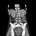 Colocolic fistula - Crohn disease (Radiopaedia 57063-63955 B 33).jpg