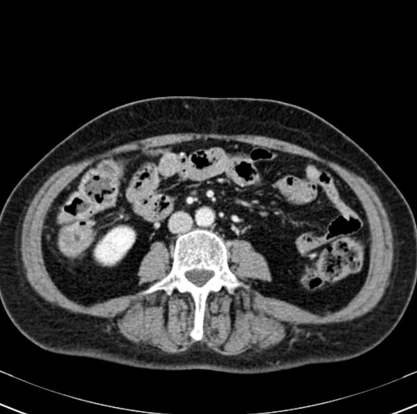 File:Colon carcinoma with hepatic metastases (Radiopaedia 29477-29961 A 62).jpg