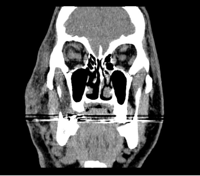 File:Necrobiotic xanthogranuloma- face (Radiopaedia 29549-30052 A 7).jpg