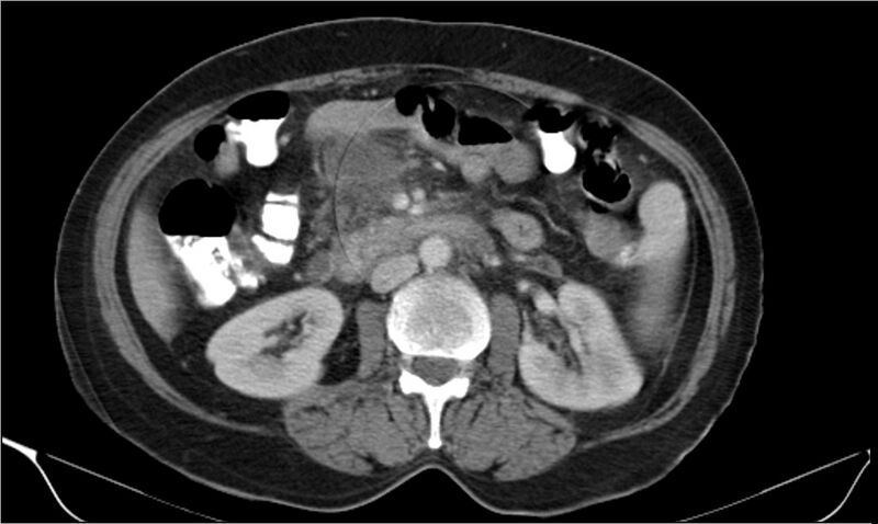 File:Necrotizing pancreatitis (Radiopaedia 20595-20495 A 19).jpg