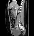 Necrotizing pancreatitis (Radiopaedia 23001-23031 C 30).jpg