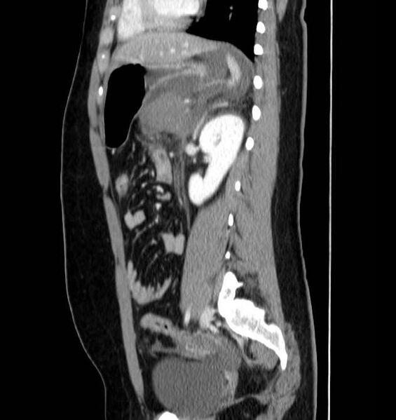 File:Necrotizing pancreatitis (Radiopaedia 23001-23031 C 51).jpg