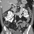 Necrotizing pancreatitis with acute necrotic collection (Radiopaedia 14470-14417 C 18).jpg