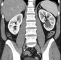 Necrotizing pancreatitis with acute necrotic collection (Radiopaedia 14470-14417 C 30).jpg