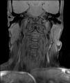 Neurofibromatosis type 1 (Radiopaedia 80355-93740 Coronal T1 3).jpg