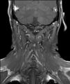 Neurofibromatosis type 1 (Radiopaedia 80355-93740 I 12).jpg