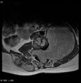 Neurofibromatosis type 2 - cranial and spinal involvement (Radiopaedia 5351-7112 Axial T1 C+ 23).jpg