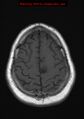 Neuroglial cyst (Radiopaedia 10713-11184 Axial T1 4).jpg