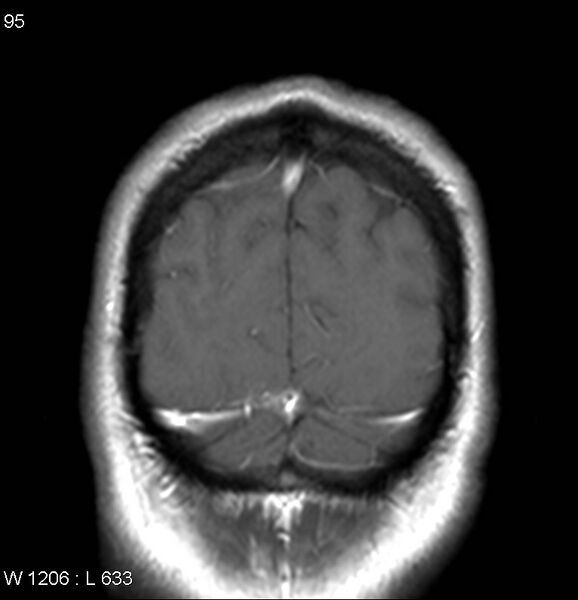 File:Neurosarcoidosis (Radiopaedia 10930-17204 Coronal T1 C+ 19).jpg