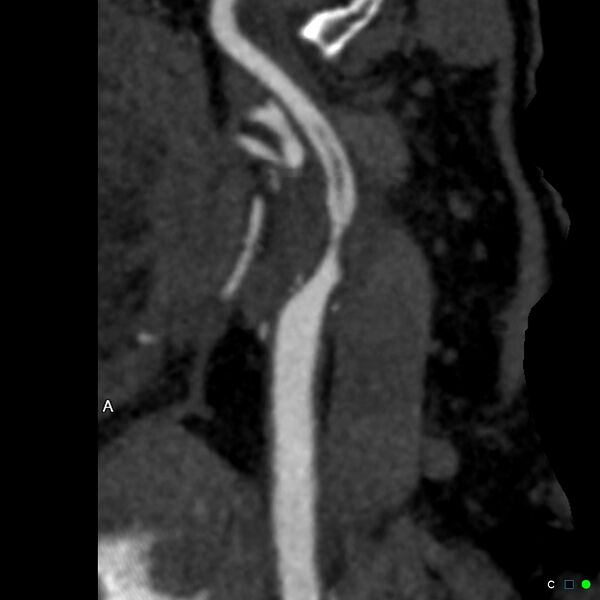 File:Non-occlusive intraluminal internal carotid artery thrombus (Radiopaedia 37751-39658 A 48).jpg