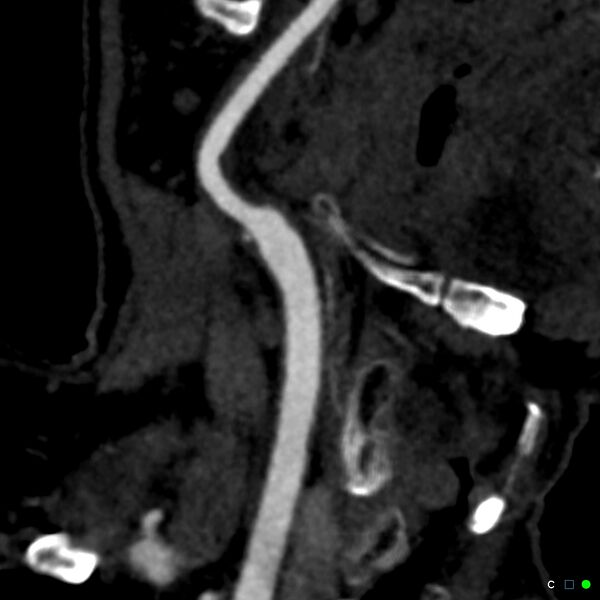 File:Non-occlusive intraluminal internal carotid artery thrombus (Radiopaedia 37751-39658 C 28).jpg