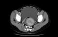 Non-puerperal uterine inversion (Radiopaedia 78343-91094 A 38).jpg