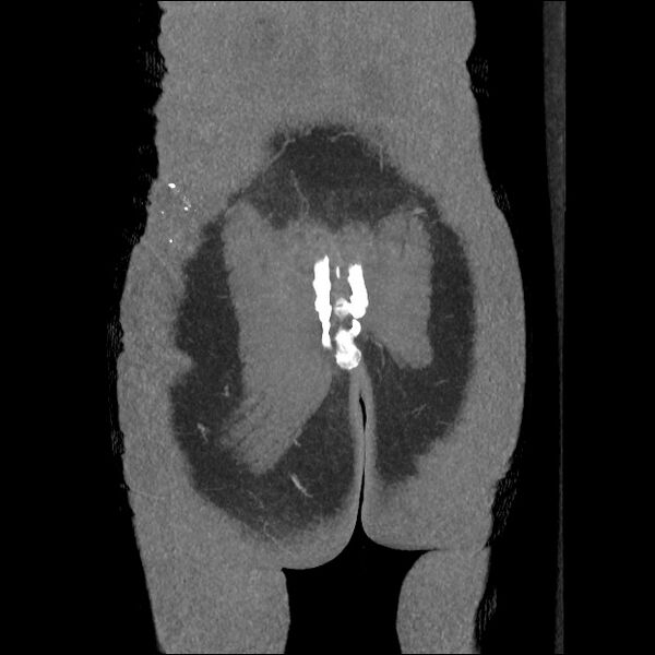File:Normal CT angiogram of pelvis (Radiopaedia 45390-49430 B 45).jpg