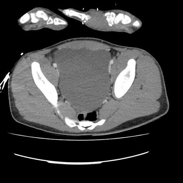 File:Normal dual-phase trauma CT chest,abdomen and pelvis (Radiopaedia 48092-52899 A 101).jpg