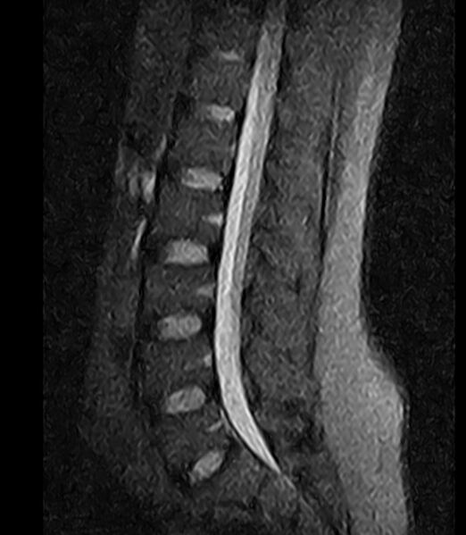 File:Normal lumbar spine MRI - low-field MRI scanner (Radiopaedia 40976-43699 Sagittal STIR 6).jpg