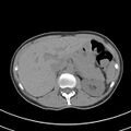 Normal multiphase CT liver (Radiopaedia 38026-39996 Axial non-contrast 20).jpg