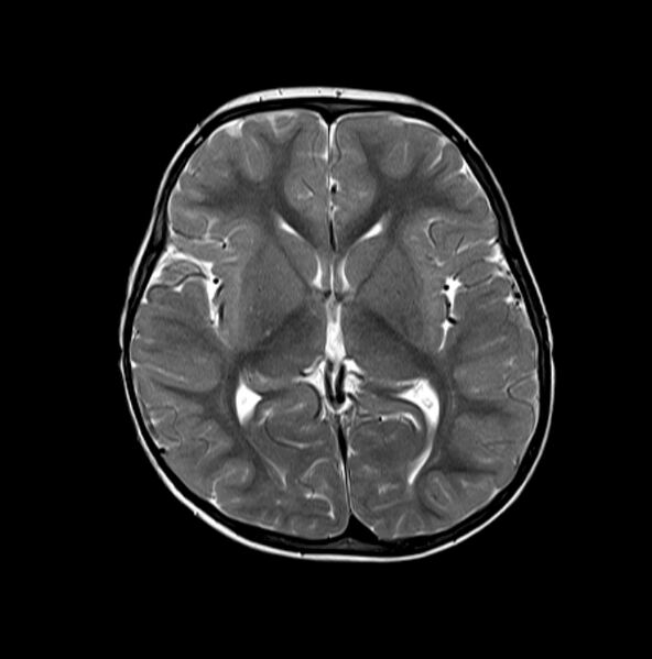 File:Normal myelination 2 year old (Radiopaedia 6815-7983 Axial T2 1).jpg