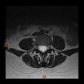 Normal spine MRI (Radiopaedia 77323-89408 Axial T2 12).jpg