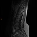 Normal spine MRI (Radiopaedia 77323-89408 Sagittal T1 9).jpg