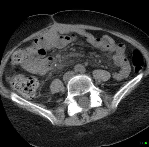 File:Obstructed infected horseshoe kidney (Radiopaedia 18116-17898 non-contrast 25).jpg