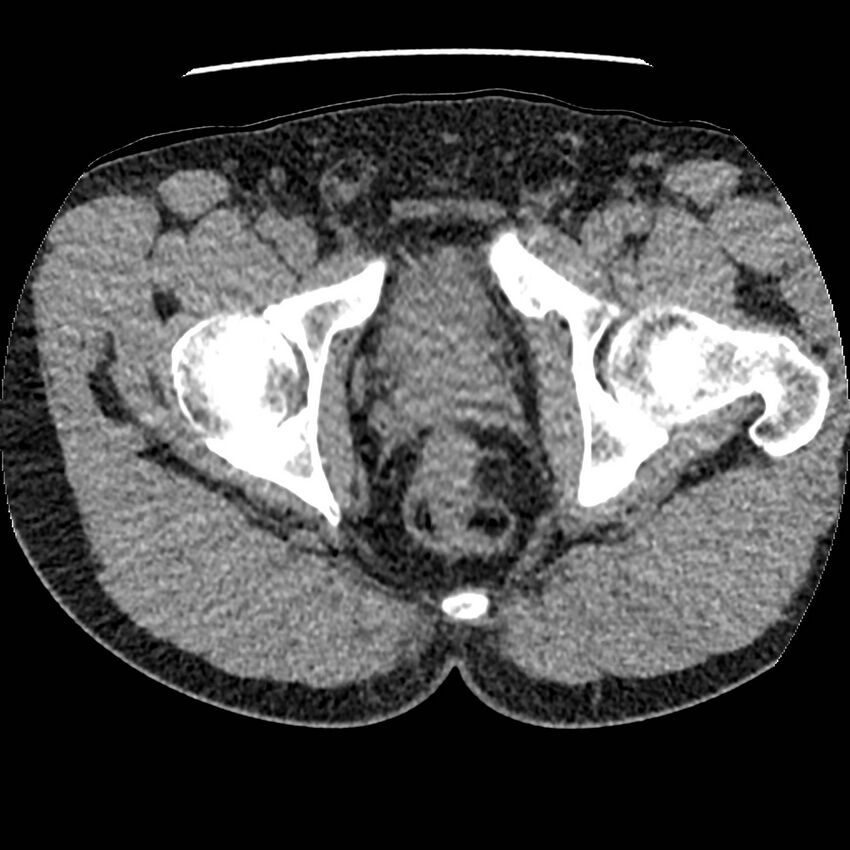 Obstructing ureteric calculus and ureteric anatomy (Radiopaedia 62730-71042 Axial non-contrast 167).jpg