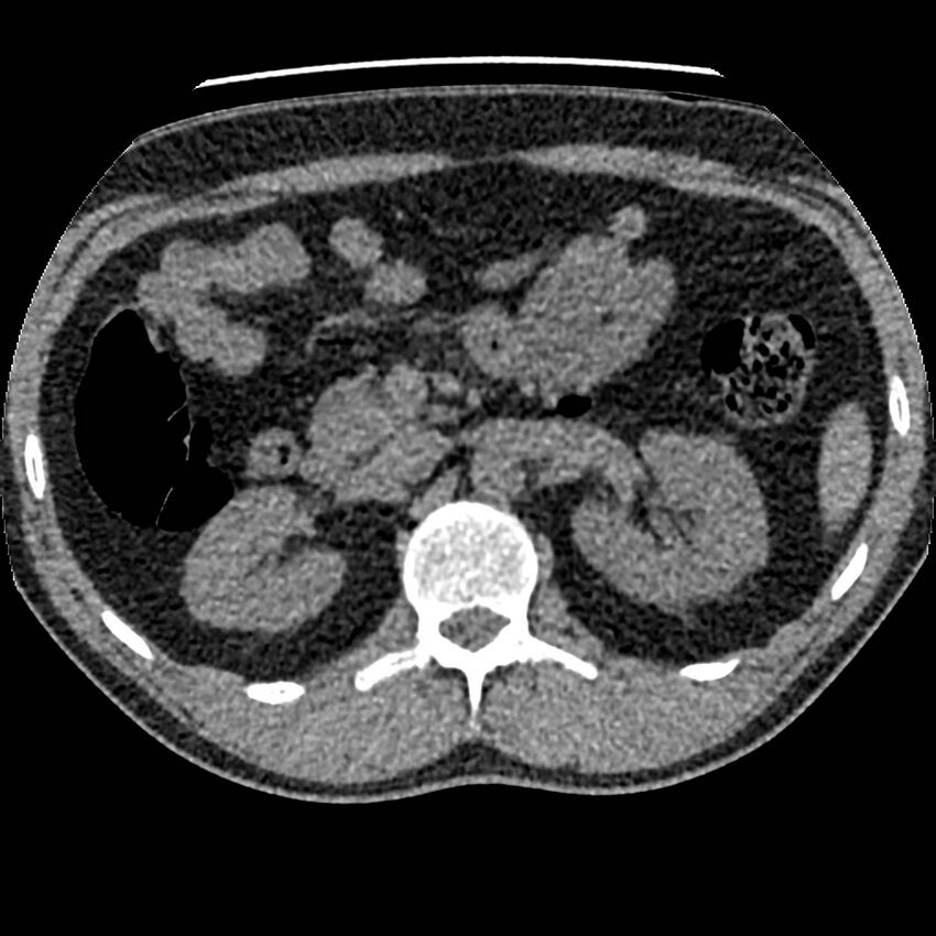 Obstructing ureteric calculus and ureteric anatomy (Radiopaedia 62730-71042 Axial non-contrast 33).jpg