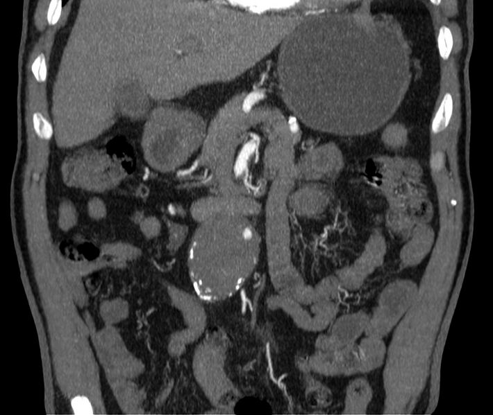 File:Abdominal aortic aneurysm (Radiopaedia 22421-22458 C 12).jpg
