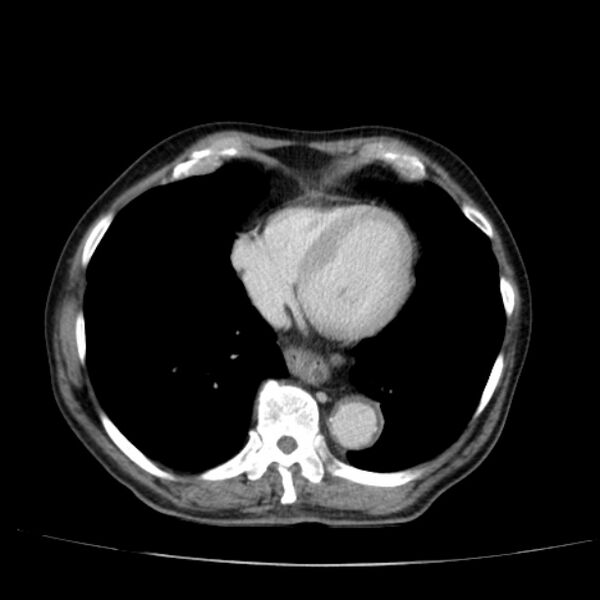 File:Abdominal aortic aneurysm (Radiopaedia 29248-29660 Axial C+ portal venous phase 4).jpg