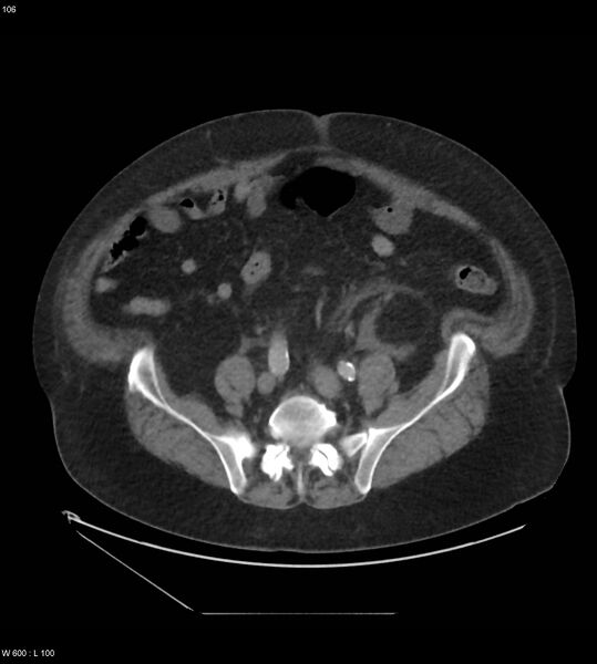 File:Abdominal aortic aneurysm with intramural hematoma then rupture (Radiopaedia 50278-55631 Axial C+ arterial phase 97).jpg