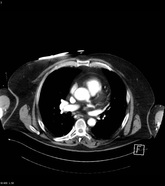File:Abdominal aortic aneurysm with intramural hematoma then rupture (Radiopaedia 50278-55632 Axial C+ arterial phase 2).jpg