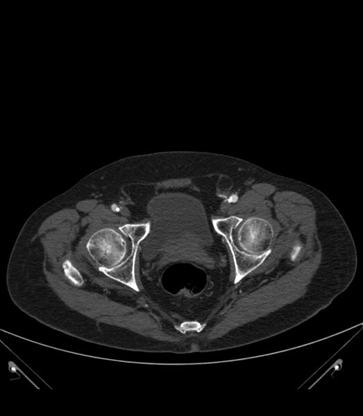 File:Abdominal aortic aneurysm with thrombus fissuration (Radiopaedia 46218-50618 Axial C+ arterial phase 42).jpg