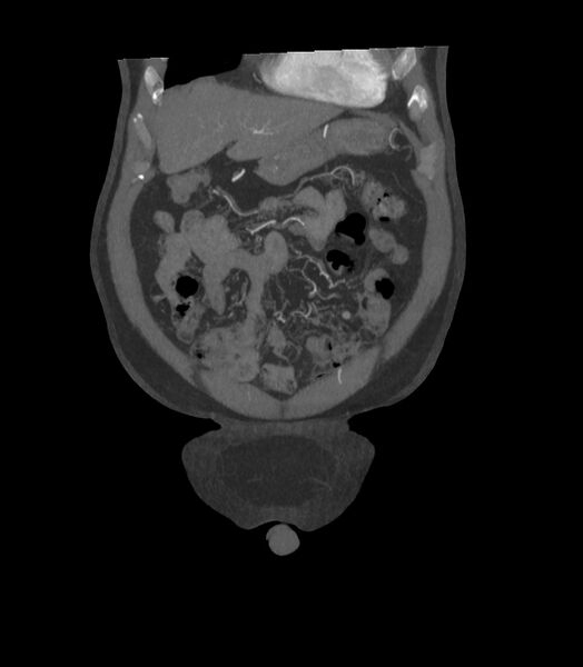 File:Abdominal aortic aneurysm with thrombus fissuration (Radiopaedia 46218-50618 Coronal C+ arterial phase 34).jpg