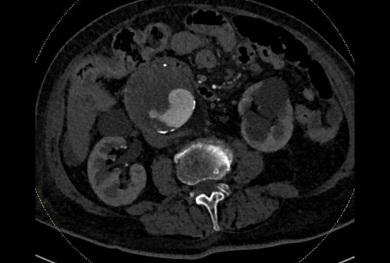 File:Abdominal aortic aneurysm with thrombus fissuration (Radiopaedia 73192-83919 Axial C+ arterial phase 97).jpg