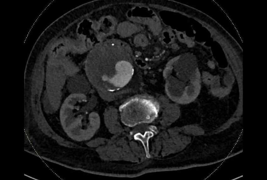 Abdominal aortic aneurysm with thrombus fissuration (Radiopaedia 73192-83919 Axial C+ arterial phase 97).jpg