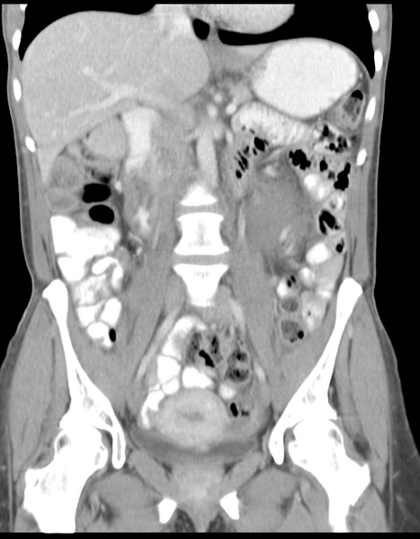 File:Abdominal desmoid tumor (Radiopaedia 41007-43740 Coronal C+ portal venous phase 20).png