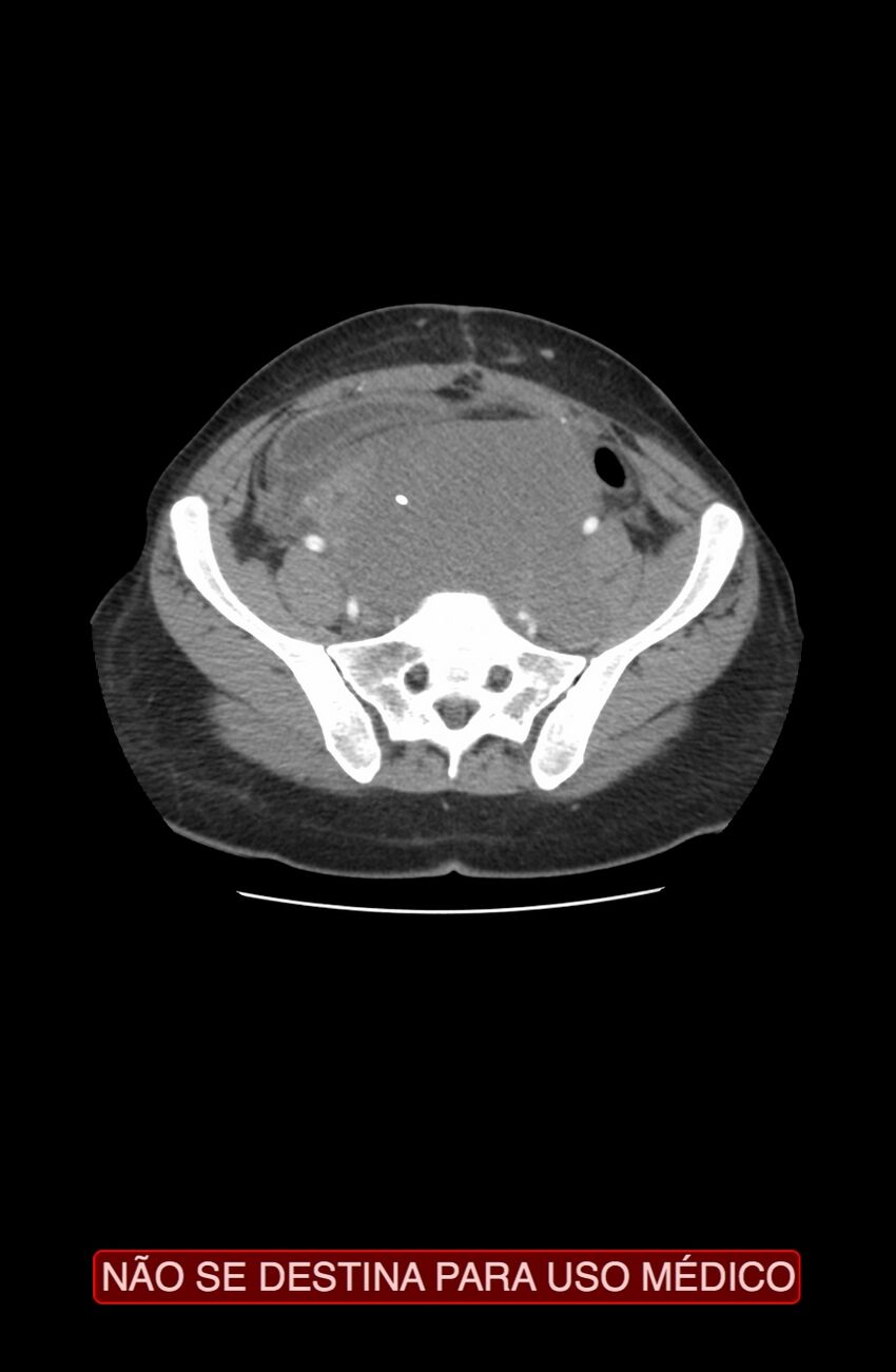 Abdominal desmoid tumor (Radiopaedia 44024-47540 Axial C+ arterial phase 32).jpg