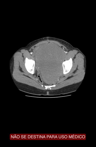 File:Abdominal desmoid tumor (Radiopaedia 44024-47540 Axial C+ arterial phase 46).jpg