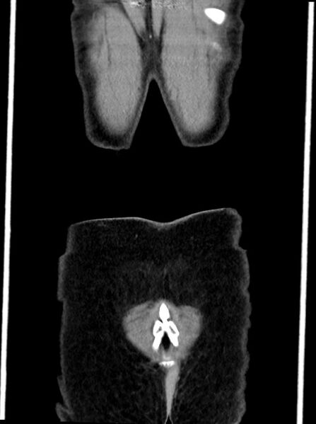 File:Abdominal wall and retroperitoneal tuberculosis (Radiopaedia 88137-104729 Coronal C+ portal venous phase 101).jpg