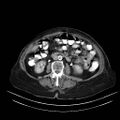 Abdominal wall recurrence after colorectal resection for cancer (Radiopaedia 23444-23523 Axial C+ portal venous phase 15).jpg
