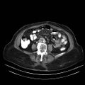 Abdominal wall recurrence after colorectal resection for cancer (Radiopaedia 23444-23523 Axial C+ portal venous phase 19).jpg