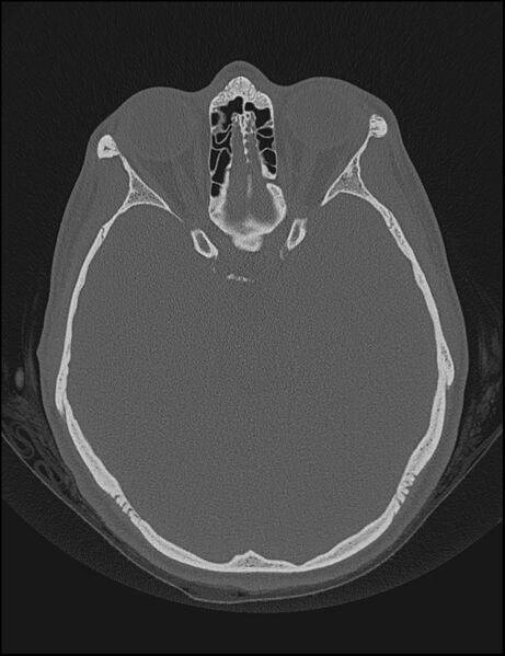 File:Aberrant right internal carotid artery (Radiopaedia 65191-74198 Axial non-contrast 73).jpg