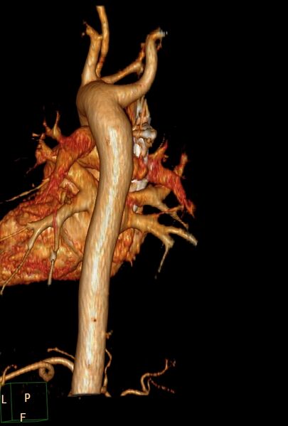 File:Aberrant right subclavian artery (Radiopaedia 67135-76475 B 6).jpg