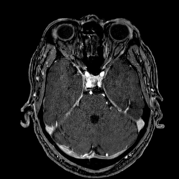 File:Accessory middle cerebral artery (Radiopaedia 73114-83828 Axial MRA 55).jpg