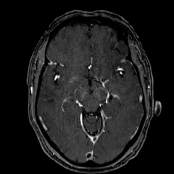 File:Accessory middle cerebral artery (Radiopaedia 73114-83828 Axial MRA 82).jpg