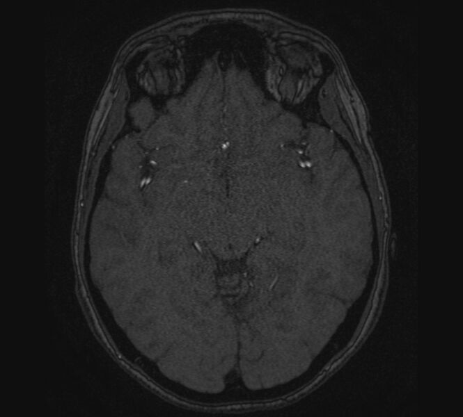 File:Accessory middle cerebral artery and ICA aneurysm (Radiopaedia 22656-22674 MRA 61).jpg