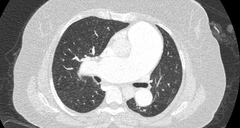 File:Accessory right inferior hepatic vein (Radiopaedia 65245-74259 Axial lung window 31).jpg
