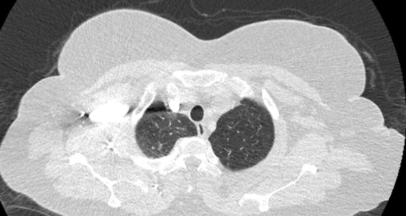 File:Accessory right inferior hepatic vein (Radiopaedia 65245-74259 Axial lung window 4).jpg