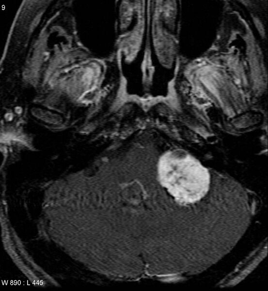 File:Acoustic schwannoma (large with cystic change) (Radiopaedia 5369-7130 Axial T1 C+ fat sat 7).jpg