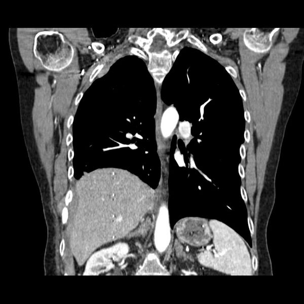 File:Acquired adrenal hyperplasia - due to thymic carcinoid tumor (Radiopaedia 21269-21184 C 5).jpg